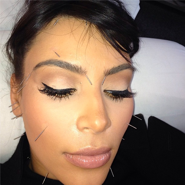 Kim Kardashian acupuncture