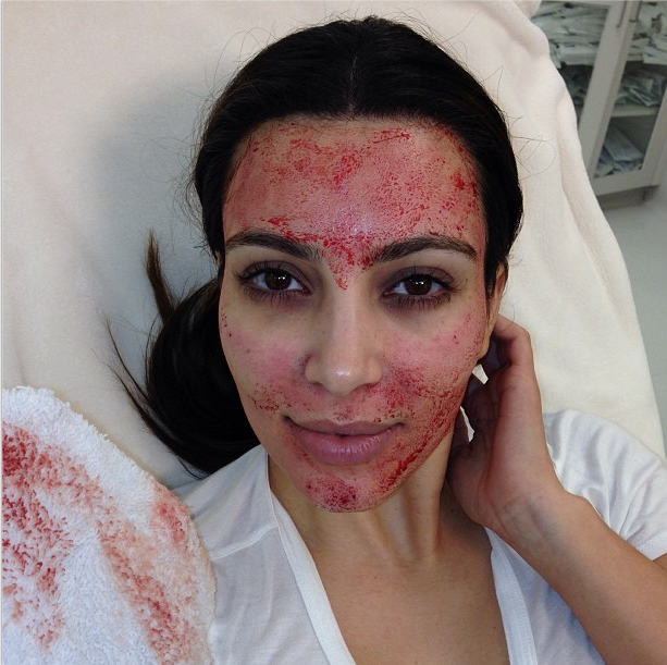 Kim Kardashian vampire facial
